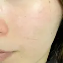 ポテンツァ 上野美容外科・美容皮膚科 BEFORE サムネイル用