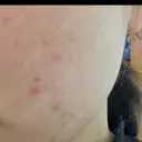 ピーリング（ニキビ・毛穴） 大美会クリニック 梅田院 BEFORE サムネイル用