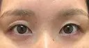 自然癒着法 銀座リシェスクリニック BEFORE サムネイル用