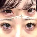 クマ治療 / 目尻切開 / タレ目形成・グラマラスライン（切開） / 脂肪注入（目の下） 藤・ナチュレ美容クリニック 銀座院 BEFORE サムネイル用