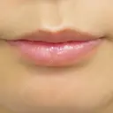 ヒアルロン酸注入（唇） / ボトックス（口角） ルラ美容クリニック 渋谷本院 BEFORE サムネイル用