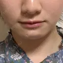 小鼻縮小（切開） / 軟骨移植 / 斜鼻修正 キップン整形外科 BEFORE サムネイル用