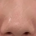 アグネス 日本美容・医療クリニック 六本木院 BEFORE サムネイル用