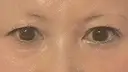 二重埋没 / その他（目元） / クマ治療 / 下まぶたの脂肪取り / 自然癒着法 / ヒアルロン酸注入（目の下） MEMOTO CLINIC 名古屋 BEFORE サムネイル用