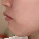 ボトックス（額） ルラ美容クリニック銀座院 BEFORE サムネイル用