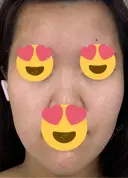 医療脱毛（顔） 日本美容・医療クリニック 六本木院 BEFORE サムネイル用