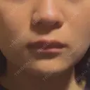 二重埋没 / 糸リフト / 脂肪吸引注射（顔） / ヒアルロン酸注入（涙袋） / 肌ヒアルロン酸注入（たるみ・シワ改善） / ヒアルロン酸注入（あご） / ボトックス（エラ・小顔） / ヒアルロン酸注入（唇） / ボトックス（口角） / シワ取りボトックス / その他（鼻） / その他（口元） TCB東京中央美容外科 熊本院 BEFORE サムネイル用