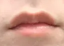 ヒアルロン酸注入（唇） / ボトックス（口角） id美容クリニック 銀座院 BEFORE サムネイル用
