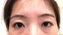 眉下切開 ビクアスクリニック BEFORE サムネイル用