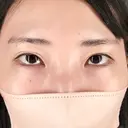 クマ治療 / ヒアルロン酸注入（目の下） / ヒアルロン酸注入（鼻翼基部） / スネコス Tokyo Tensei Clinic 銀座院 BEFORE サムネイル用