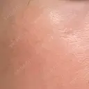 ニードルRF（ポテンツァなど） 広島プルミエクリニック BEFORE サムネイル用