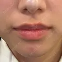 ボトックス（エラ・小顔） / ボトックス（口角） / ボトックス（眉間） / ボトックス（額） TCB東京中央美容外科 梅田茶屋町院 BEFORE サムネイル用