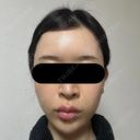 糸リフト / バッカルファット除去 / 脂肪吸引（顔） / ジョールファット除去 / ヒアルロン酸注入（額） / ヒアルロン酸注入（頬） BLINC CLINIC （ブリンク クリニック） BEFORE サムネイル用