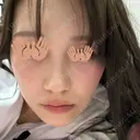 ハイフ（顔） AZ BEAUTY CLINIC BEFORE サムネイル用