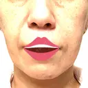 ボトックス（エラ・小顔） / ヒアルロン酸注入（頬） 新未来クリニック BEFORE サムネイル用