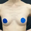 クマ治療 / 豊胸（脂肪注入） / 脂肪注入（額） / 脂肪注入（目の下） / 脂肪注入（輪郭） 湘南美容クリニック 吉祥寺院 BEFORE サムネイル用