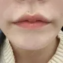 ボトックス（口角） / ボトックス（額） / ハイフ（顔） TCB東京中央美容外科 広島院 BEFORE サムネイル用