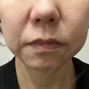 RF（高周波）たるみ治療 大美会クリニック 心斎橋本院 BEFORE サムネイル用