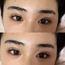ヒアルロン酸注入（涙袋） AYANAフィラーズクリニック 渋谷院 BEFORE サムネイル用