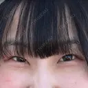 二重埋没 / 目頭切開 / 上まぶたの脂肪取り HAAB×DREAM BEAUTY CLINIC 東京本院 BEFORE サムネイル用