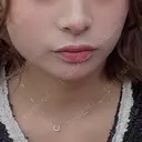 ボトックス（エラ・小顔） BiBiクリニック BEFORE サムネイル用