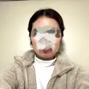 ボトックス（エラ・小顔） 新未来クリニック BEFORE サムネイル用