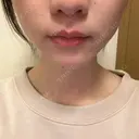 小鼻縮小（非切開） YBC横浜美容外科 池袋院 BEFORE サムネイル用