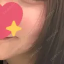 イオン導入 / 毛穴洗浄（ハイドラフェイシャルなど） 新宿Ladies&Gentlemen美容クリニック BEFORE サムネイル用