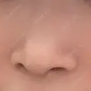 小鼻縮小（切開） キップン整形外科 BEFORE サムネイル用