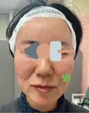 糸リフト Olino美容外科・美容皮膚科 BEFORE サムネイル用