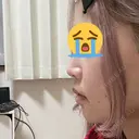 ヒアルロン酸注入（あご） BIZENNクリニック【ビゼンクリニック】 BEFORE サムネイル用