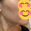 ボトックス（エラ・小顔） / ボトックス（額） TCB東京中央美容外科 長野院 BEFORE サムネイル用