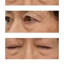 下まぶたたるみ取り WOM CLINIC GINZA （ワム クリニック ギンザ） BEFORE サムネイル用