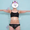 脂肪溶解注射（二の腕） / ボトックス（肩） / その他（ボディ） THE SKINNY CLINIC（ザ・スキニークリニック） BEFORE サムネイル用