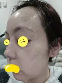 水光注射（ハリ・美肌） / 肌育注射（ジュベルックなど） Chloe Cheongdam Clinic （クロエチョンダムクリニック） BEFORE サムネイル用