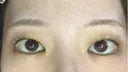 二重埋没 湘南美容クリニック 池袋東口院 BEFORE サムネイル用