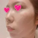 クマ治療 / 額を丸く / 脂肪吸引（脚） / レディエッセ注入（鼻） THE CLINIC（ザ・クリニック） 東京院 BEFORE サムネイル用