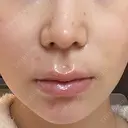 人中短縮 聖心美容クリニック 六本木院 BEFORE サムネイル用