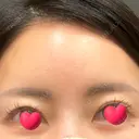 眉下切開 YBC横浜美容外科 池袋院 BEFORE サムネイル用