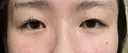 二重埋没 / 上まぶたの脂肪取り THE FIRST CLINIC 多摩センター院 BEFORE サムネイル用