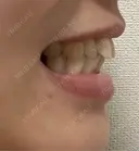 矯正（マウスピース） SF六本木東京 dental orthodontics BEFORE サムネイル用