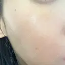 ルメッカ ルラ美容クリニック銀座院 BEFORE サムネイル用