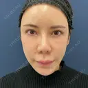 鼻尖形成（切開） / 軟骨移植 東京シンデレラ美容外科 池袋院 BEFORE サムネイル用