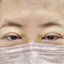 眼瞼下垂（切開） 博多もへじのクリニック BEFORE サムネイル用