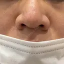 ベビーコラーゲン しのぶ皮膚科 BEFORE サムネイル用