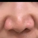 小鼻縮小（非切開） 形成外科と美容外科のクリニック池袋 BEFORE サムネイル用