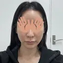 糸リフト / ボトックス（肩） / ワキ汗治療（ボトックス） DMTC CLINIC 日本橋院 BEFORE サムネイル用