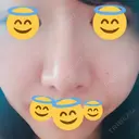 鼻孔縁挙上 / その他（鼻） シエルクリニック BEFORE サムネイル用