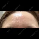 マイクロボトックス BAO CLINIC 心斎橋院 BEFORE サムネイル用