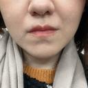 ボトックス（あご） / ボトックス（エラ・小顔） / ボトックス（口角） / シワ取りボトックス / ボトックス（眉間） 東京シルククリニック 新宿院 BEFORE サムネイル用
